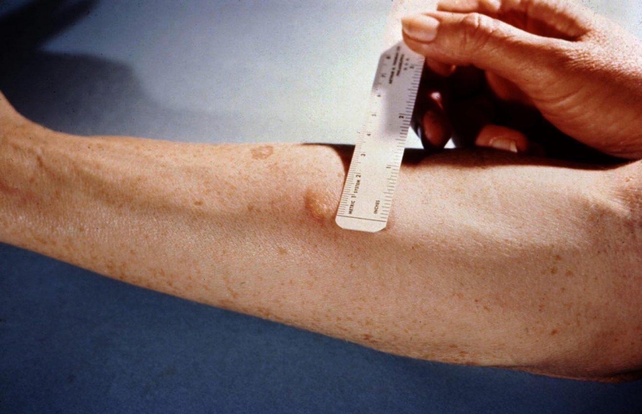 Україна починає відмовлятися від проби Манту: з квітня в регіонах впроваджуватимуть нові тести на туберкульоз